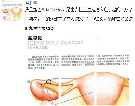 患上盆腔炎的原因(图1)